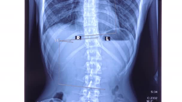 Ray Showing Scoliosis Lumbar Spine Scoliosis Abnormal Lateral Curvature Spine — Vídeos de Stock