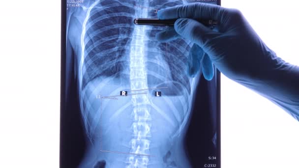 Médico Analizando Rayos Columna Vertebral Mostrando Escoliosis Área Lumbar Escoliosis — Vídeos de Stock