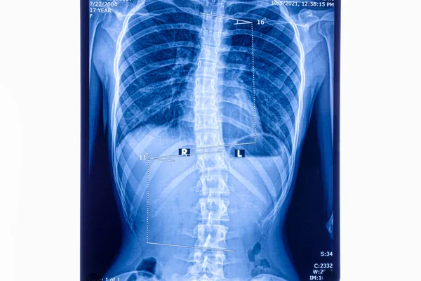 X ray showing scoliosis of the lumbar spine. Scoliosis is an abnormal lateral curvature of the spine. Zoom in.