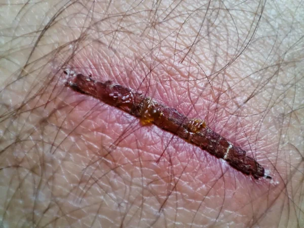 Macro Wound Human Skin Closeup Scar Skin — Stock Fotó