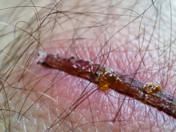 Macro Wound Human Skin Closeup Scar Skin — ストック写真