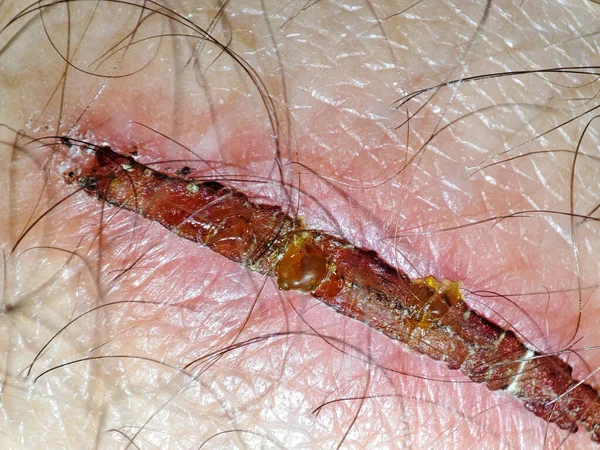 Macro Wound Human Skin Closeup Scar Skin — ストック写真