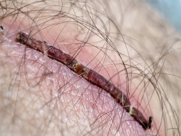 Macro Wound Human Skin Closeup Scar Skin — Stock Fotó