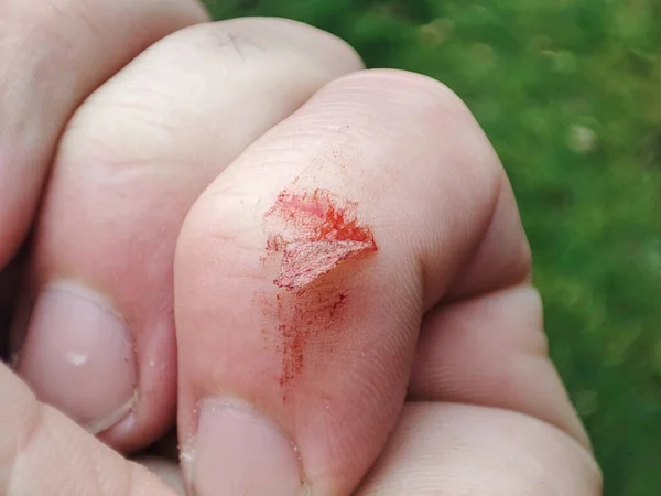 Раненый Палец Кровоточащим Открытым Порезом Глубокая Рана Поврежденный Палец Грязным — стоковое фото