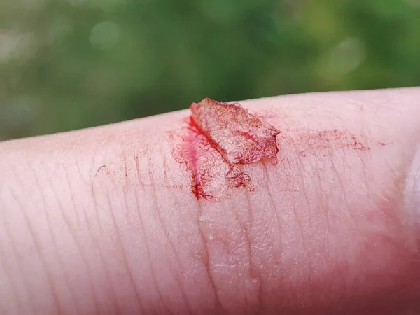 Dedo Lesionado Con Sangrado Abierto Herida Profunda Dedo Herido Con — Foto de Stock