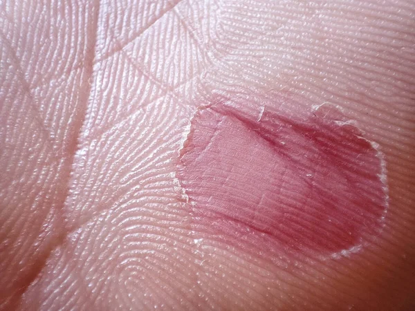 Σκληρή Δουλειά Έννοια Χέρι Πρόβλημα Δέρμα Στο Φόντο Χέρι — Φωτογραφία Αρχείου