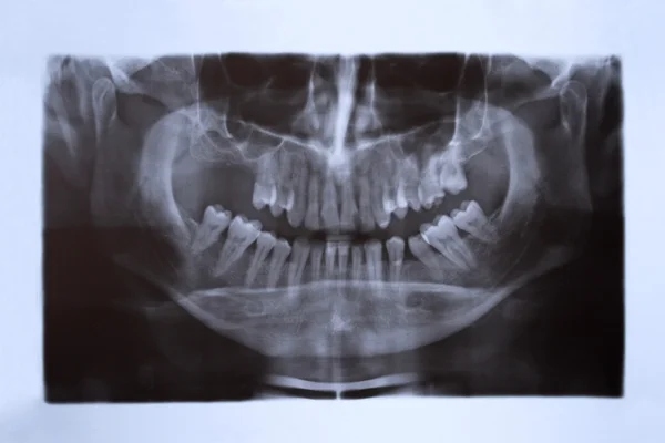 Teeth x-ray — Stock Photo, Image