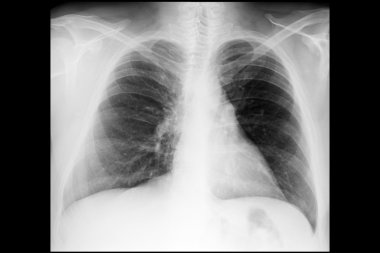 Male chest x-ray - Raio x tórax masculino clipart