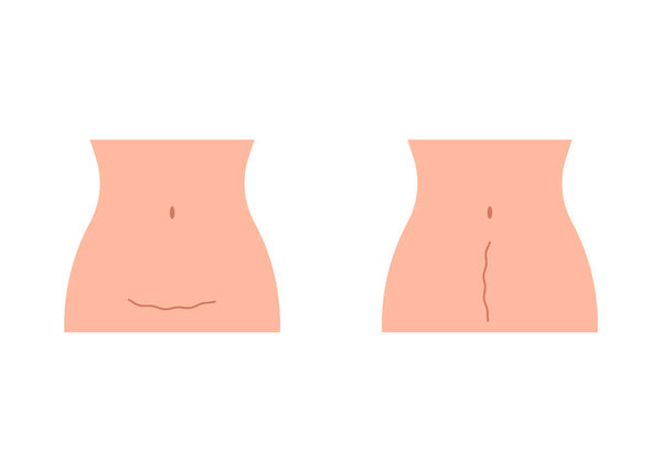 Scar on stomach woman after cesarean. Woman s belly, consequence cesarean operation. Motherhood, childbirth. Vector