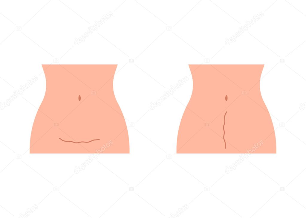 Scar on stomach woman after cesarean. Woman s belly, consequence cesarean operation. Motherhood, childbirth. Vector