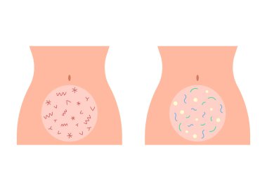 Karın bağırsağında sağlıklı ve kötü ağrı mikroflorası var. Sindirim bağırsağı. Zararlı ve yararlı bakterili bir kadın vücudu. Vektör