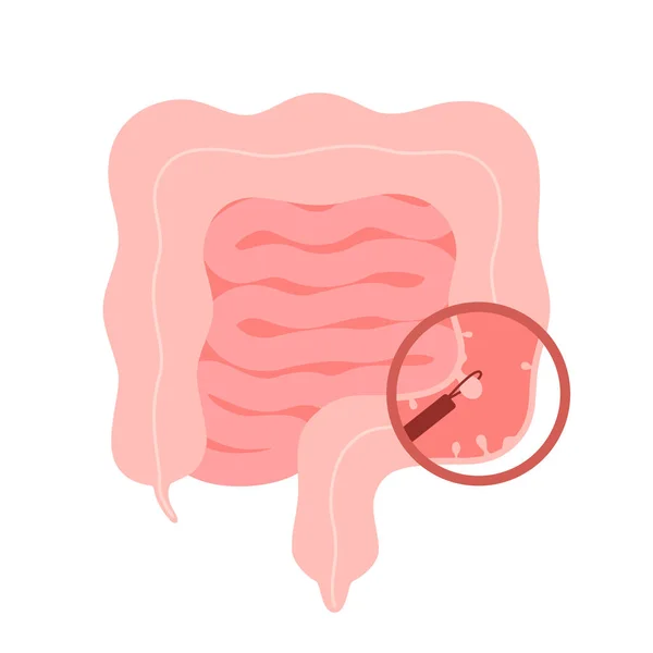 Colonoscopy Intestine Polypectomy Procedure Removal Polyp Colon Checkup Gut Colon — Stock Vector