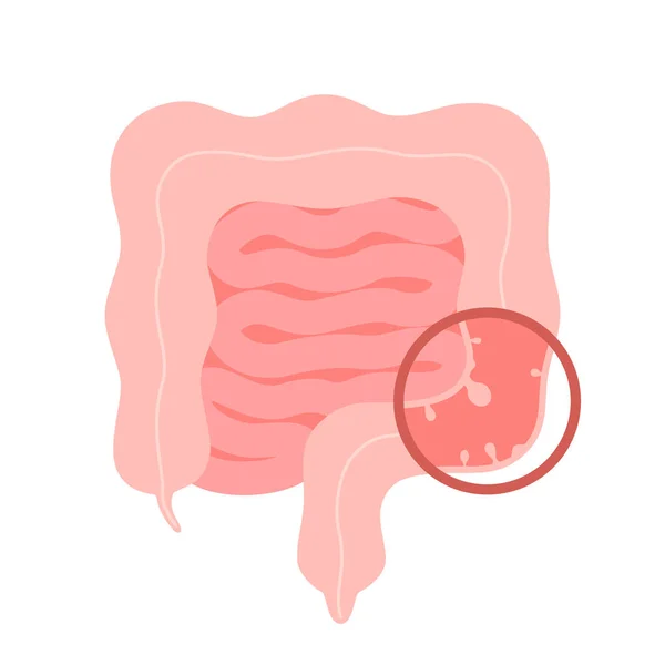 Colonoscopy intestine, polypectomy procedure, removal polyp in colon. Checkup gut, colon surgery. Operation intestine. Vector illustration — Stock Vector