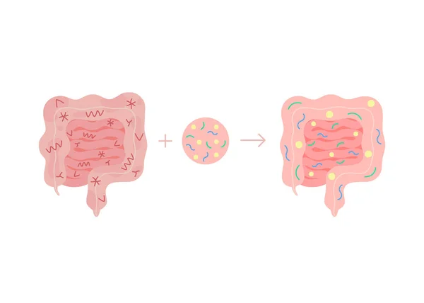 Fekal mikrobiota transplantation från friska i ohälsosam tarm, FMT. Förbättring intestinal mikroflora och normalisering avföring genom att införa nyttiga bakterier i tarmkanalen. Vektor — Stock vektor