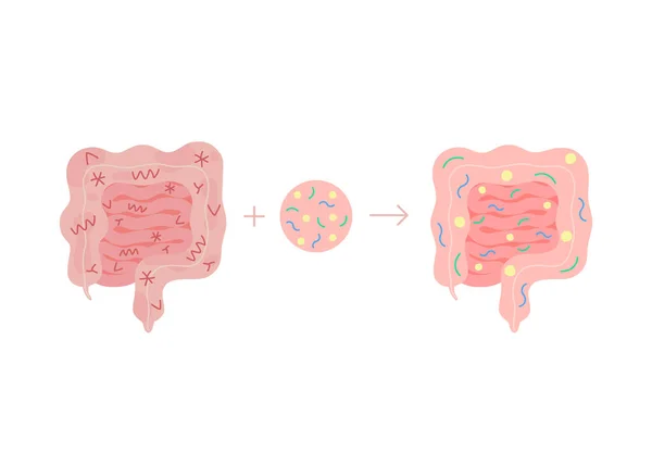 不健康な腸内の健康からの糞便微生物叢の移植, FMT.腸管結腸管に有益な細菌を導入することによって腸内細菌叢と正規化便を改善します。ベクトル ロイヤリティフリーのストックイラスト