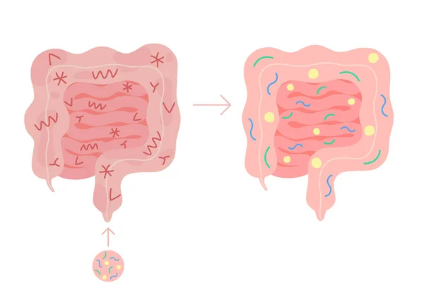Fecal Microbiota transplantation from healthy in unhealthy intestine, FMT.通过在肠道结肠道引入有益的细菌，改善肠道菌群和正常粪便。B.病媒 — 图库矢量图片