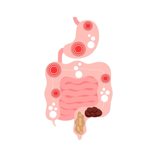 Síndrome Intestino Irritável Sii Sintomas Intestino Estômago Dor Inchaço Flatulência — Vetor de Stock