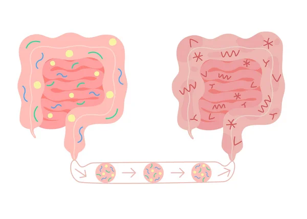 Fecal Microbiota Transplantation Healthy Unhealthy Intestine Fmt 通过在肠道结肠道引入有益的细菌 改善肠道菌群和正常粪便 矢量说明 — 图库矢量图片