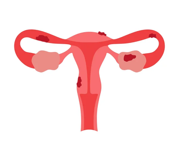 子宮内膜症婦人科健康障害 子宮内膜の過剰増殖 癌や不妊症の女性のリスク ベクトル — ストックベクタ