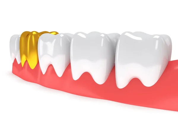 Tanden op tandvlees geïsoleerd op witte achterzijde. — Stockfoto
