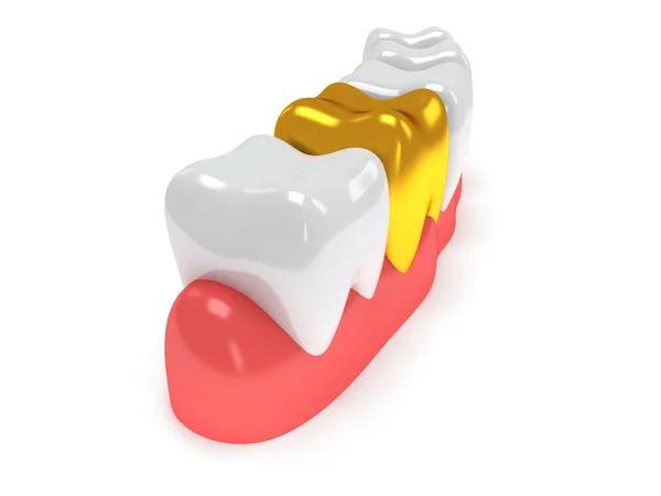 Dentes na gengiva isolados nas costas brancas . — Fotografia de Stock