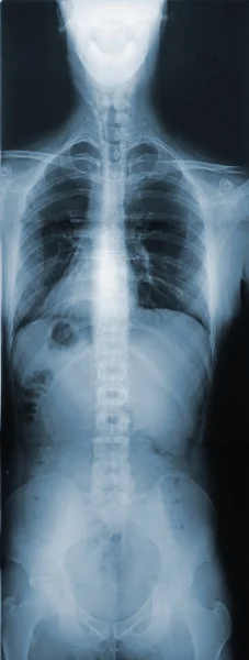 X-Ray of the Torso