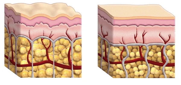 Cellulite cross section — Stock Photo, Image