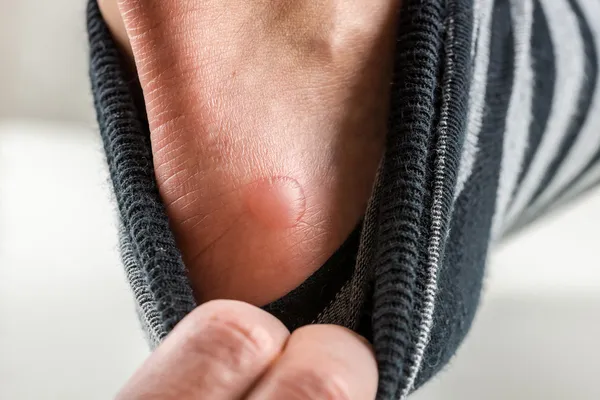 Uomo con un blister sul tallone — Foto Stock