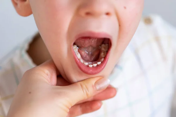 Dentes de tubarão de crianças, primeiro dente que aparece na infância atrás de dentes de leite . — Fotografia de Stock