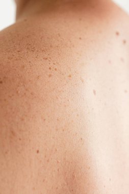 Pigmentasyon. Sırtında benleri ve çilleri olan bir adamın çıplak derisinin detaylarını kapat. İyi huylu köstebekleri kontrol ediyorum. Deride doğum lekeleri