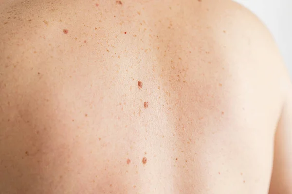 Pigmentation. Close up detail of the bare skin on a man back with scattered moles and freckles. Checking benign moles. Birthmarks on skin