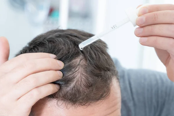 Muž Pomocí Léčby Vypadávání Vlasů Hlavě — Stock fotografie