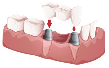 Dental bridge clipart