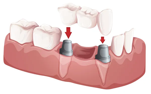 Puente dental — Vector de stock