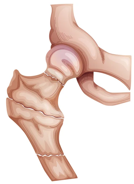 Fractures de la hanche — Image vectorielle