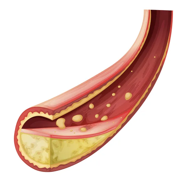 Arteria bloccata con colesterolo — Vettoriale Stock
