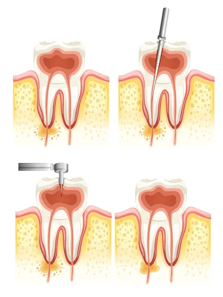 Canal radicular dental — Vector de stock