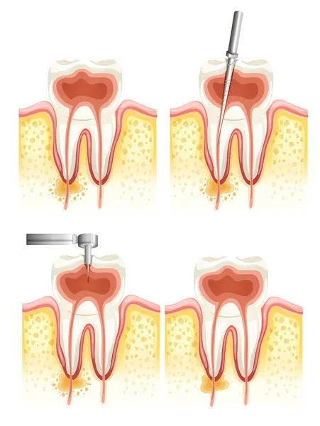 Dental root canal — Stock Vector