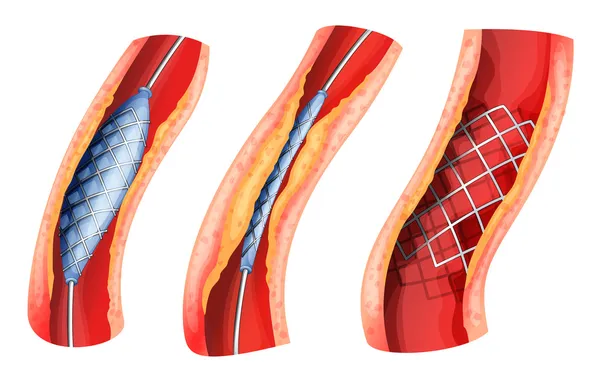 Stent utilizado para abrir la arteria bloqueada — Archivo Imágenes Vectoriales