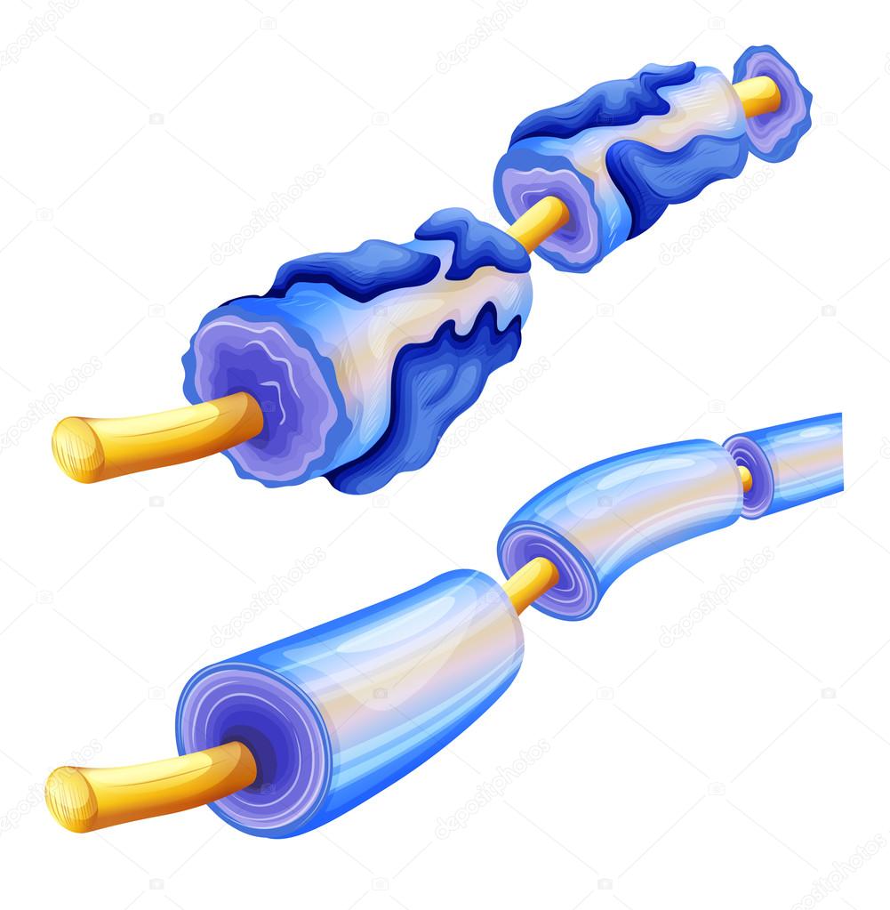 Myelin deterioration