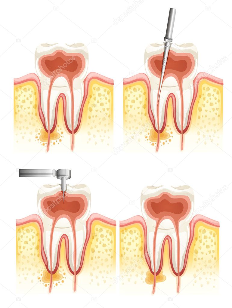 Dental root canal