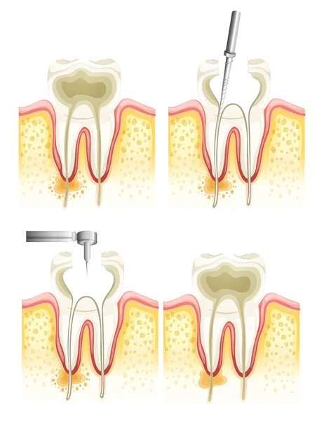 Root canal process — Stock Vector