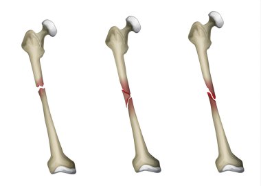 bone fracture clipart