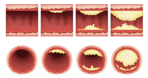 Plaque accumulation — Stock Vector