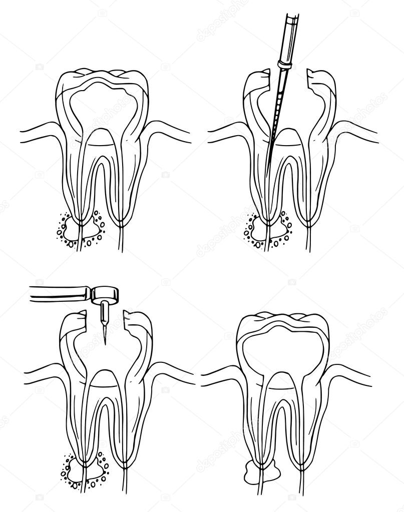 Root canal procedure Stock Vector Image by ©blueringmedia 16809403