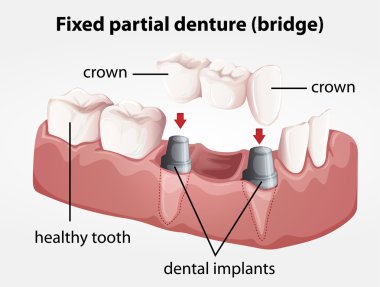 Fixed partial denture bridge clipart