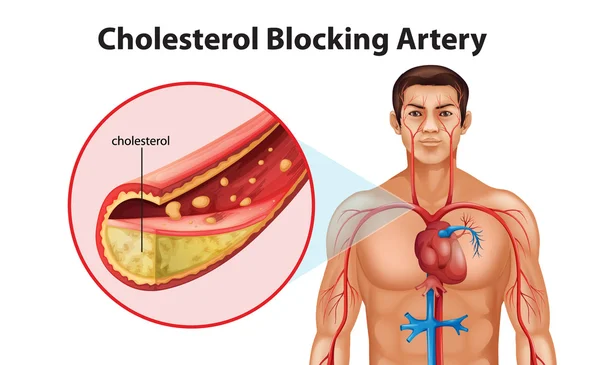 Ateriosclerosis — Vector de stock