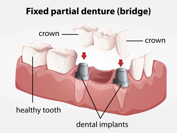 Puente de dentadura parcial fija — Vector de stock