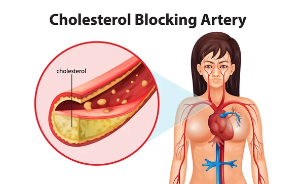 Ateriosclerosis — Archivo Imágenes Vectoriales