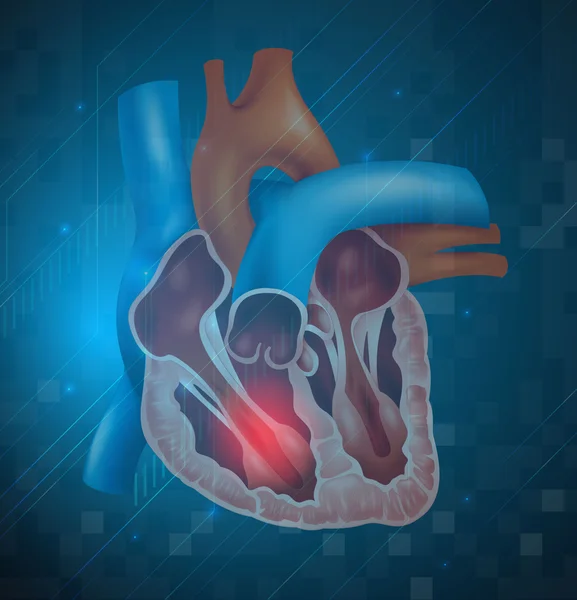 Сердечный приступ — стоковый вектор